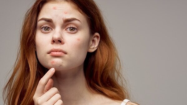 FAQs about honey for pimples