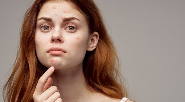 FAQs about honey for pimples