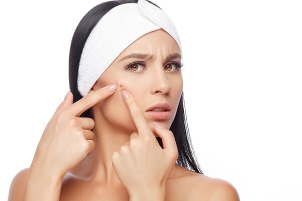 FAQs about honey for pimples