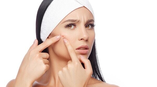 FAQs about honey for pimples