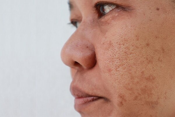 FAQs about skin pigmentation