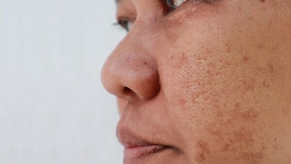 FAQs about skin pigmentation