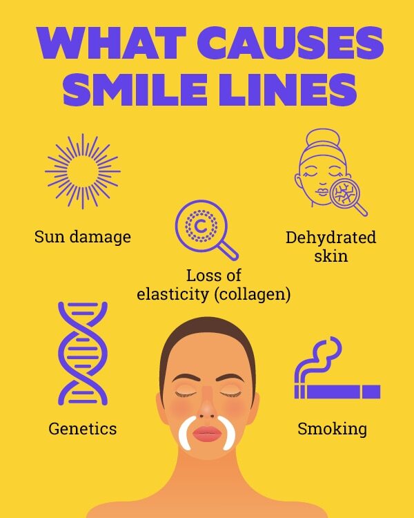 Treating smile lines at home