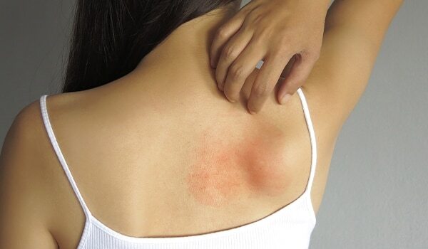 How To Tell The Difference Between Dry Skin, Eczema And Psoriasi