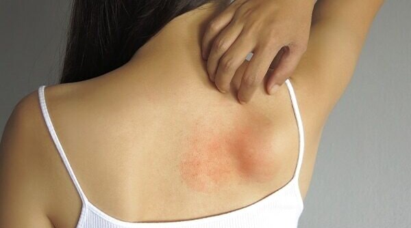 How To Tell The Difference Between Dry Skin, Eczema And Psoriasi