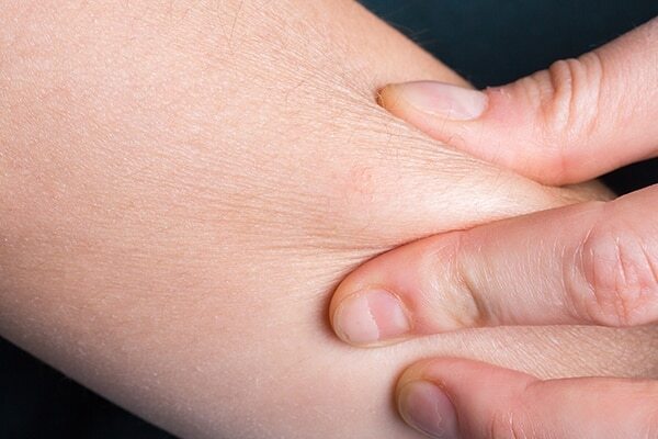 Psoriasis