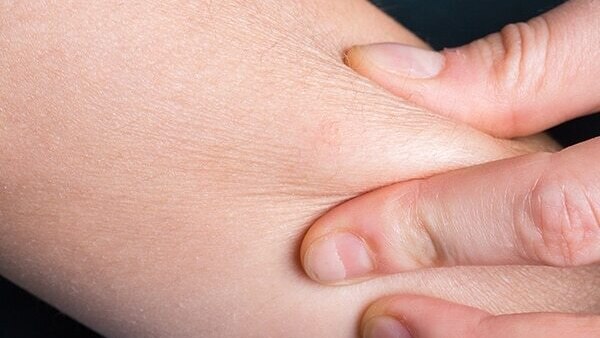 Psoriasis