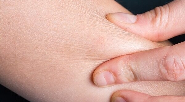 Psoriasis