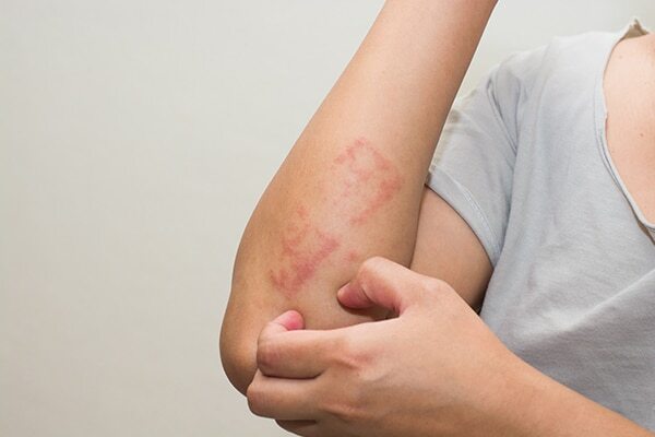 Psoriasis
