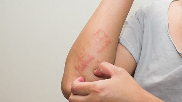 Psoriasis