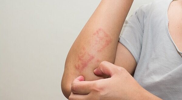 Psoriasis
