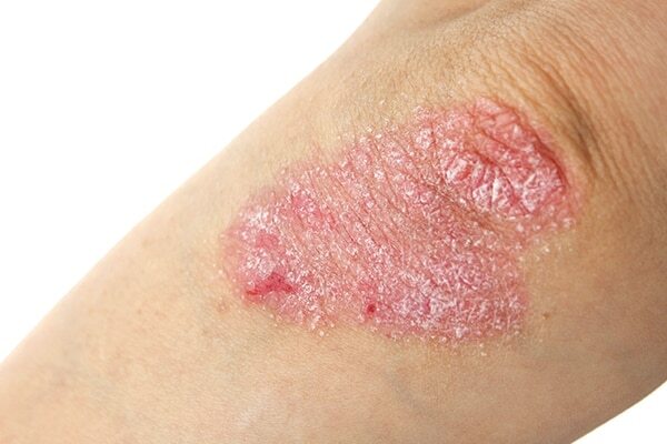 Psoriasis
