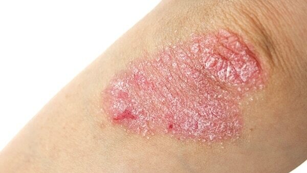 Psoriasis