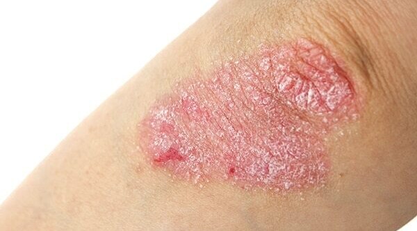 Psoriasis