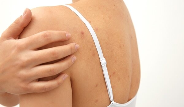 Heat Boils No More! Treat Them With These Simple HomeRemedies