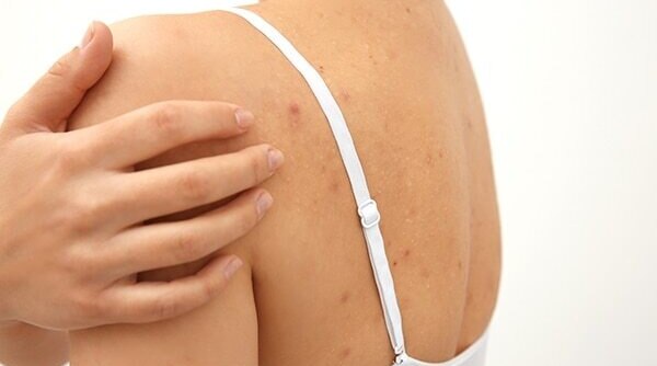 Heat Boils No More! Treat Them With These Simple HomeRemedies