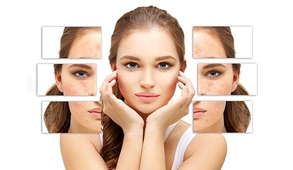 Acne Scars Haunting You? Here Are 5 Natural Ways To Get Rid Of Them Now