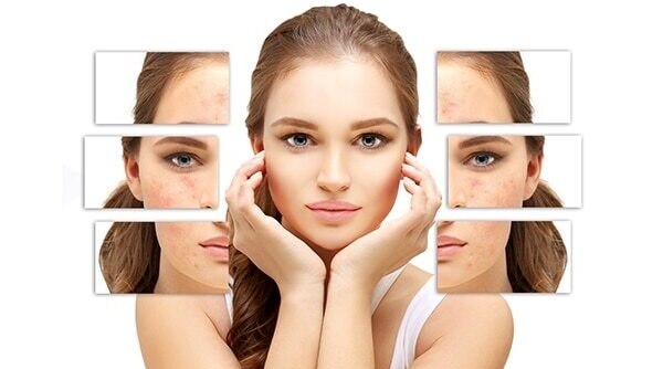 Acne Scars Haunting You? Here Are 5 Natural Ways To Get Rid Of Them Now