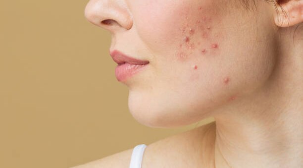 FAQs about Pimple Removal