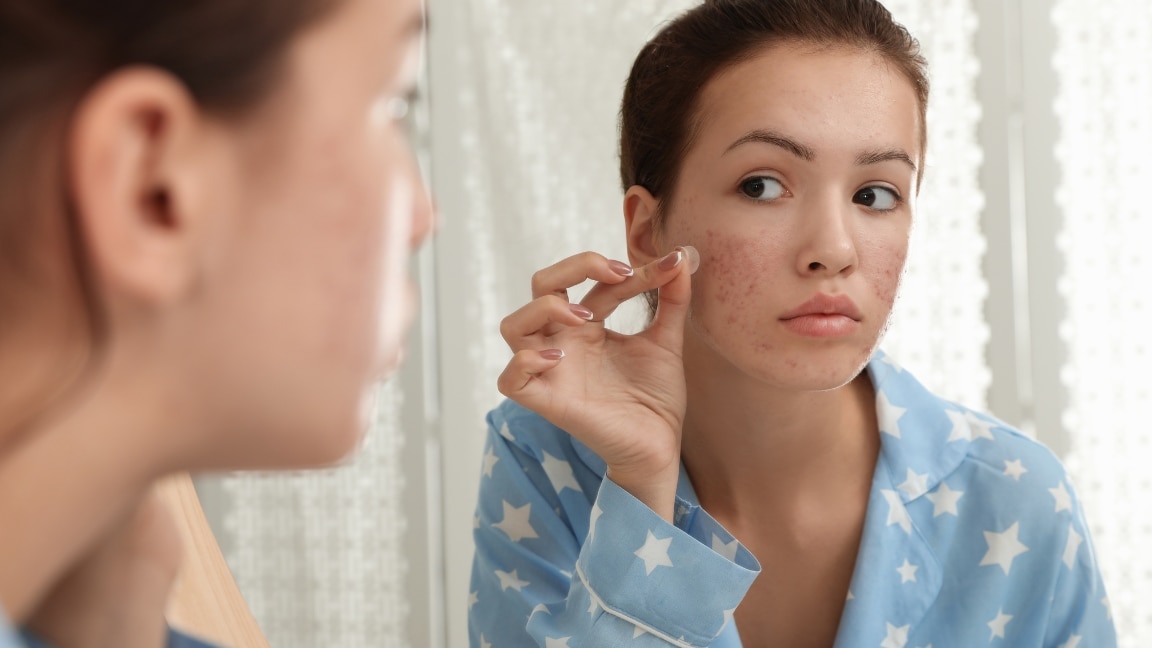 How to Choose the Best Products for Acne Scars