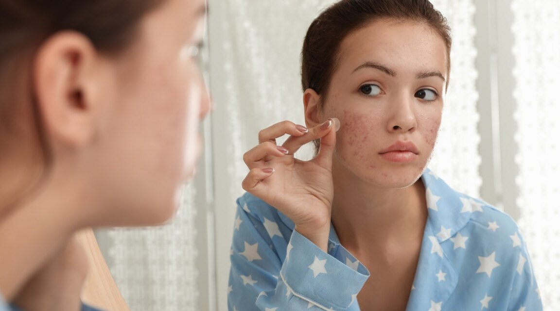 How to Choose the Best Products for Acne Scars