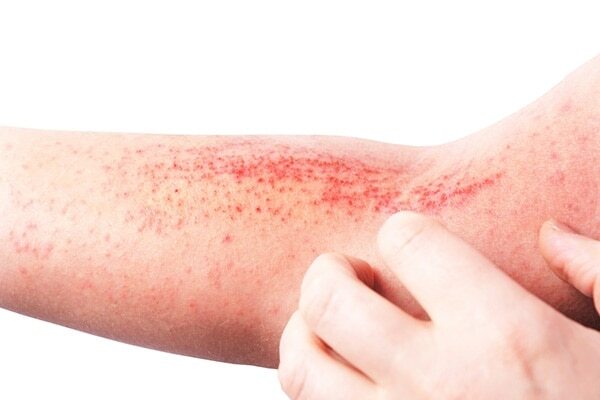 Molluscum Virus
