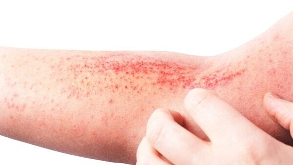 Molluscum Virus