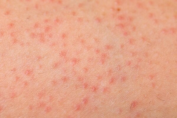 Molluscum Virus