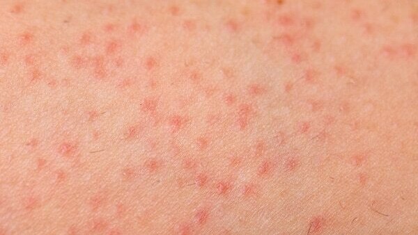 Molluscum Virus