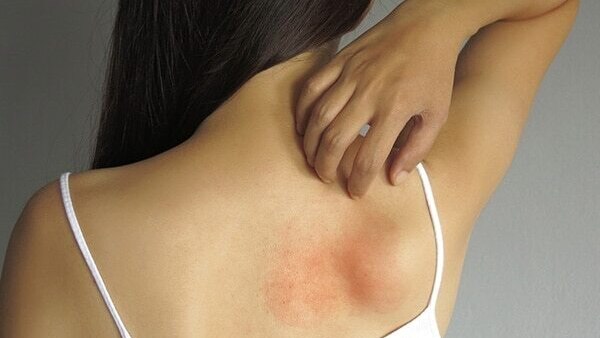 Molluscum Virus