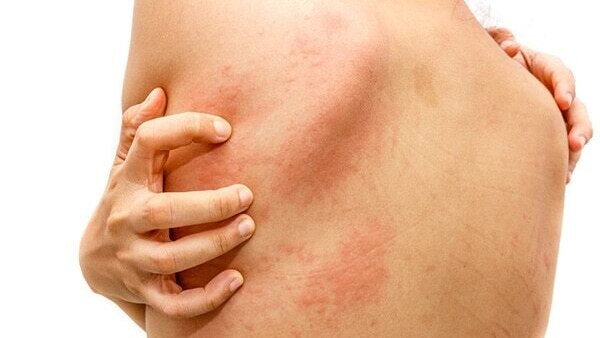 Molluscum Virus