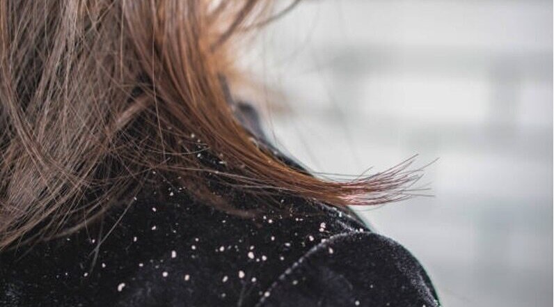 FAQs about Benefits of Aloe Vera for hair