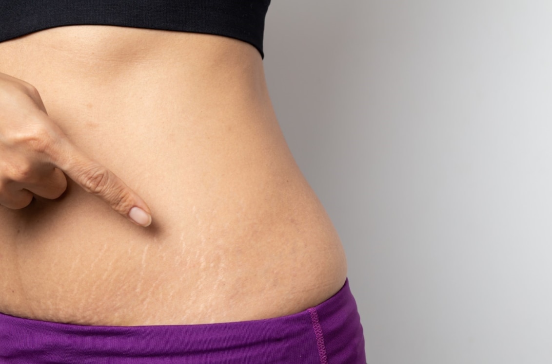 Prevent Stretch Marks