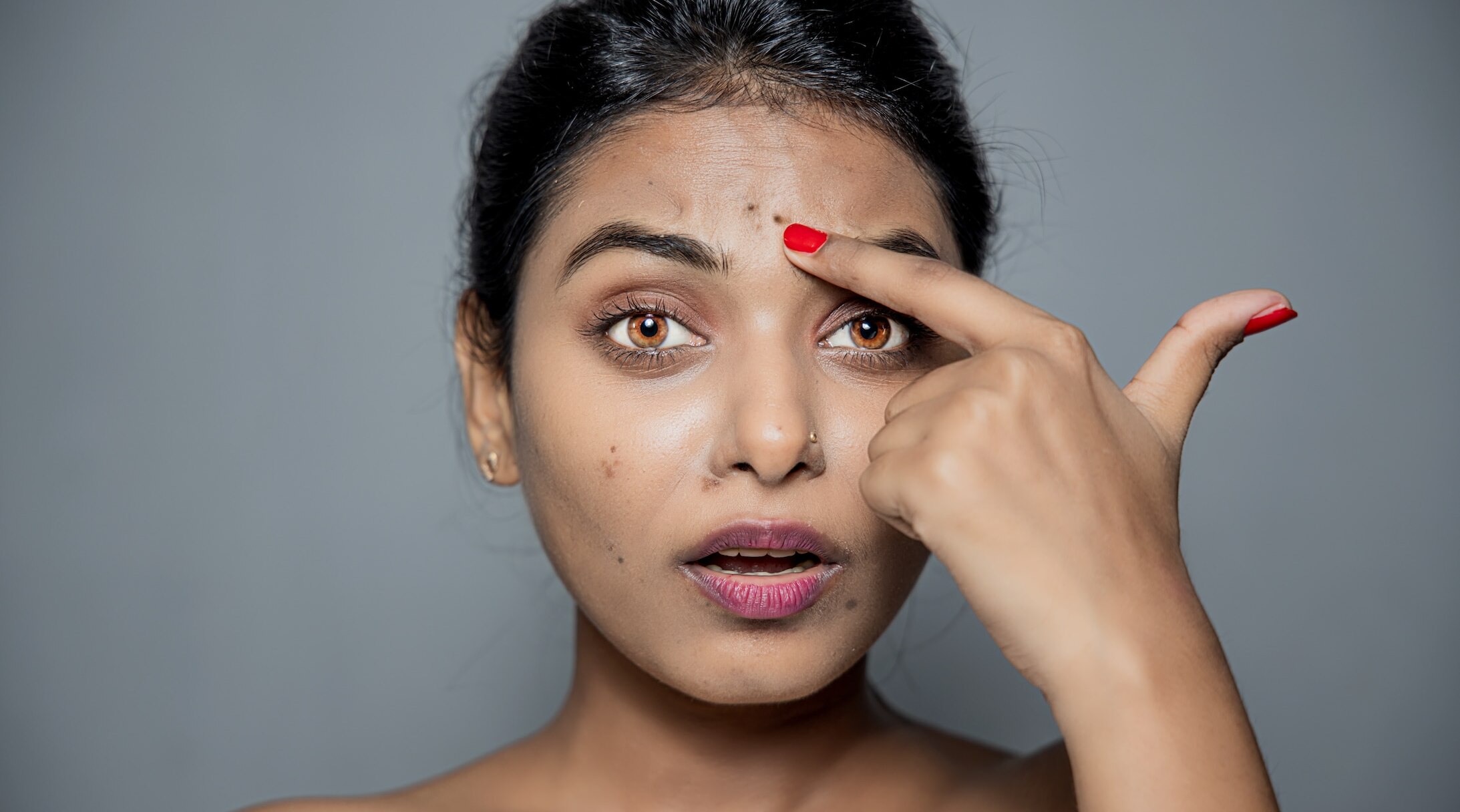 Remove Dark Spots Caused By Pimples: A Step-By-Step Guide