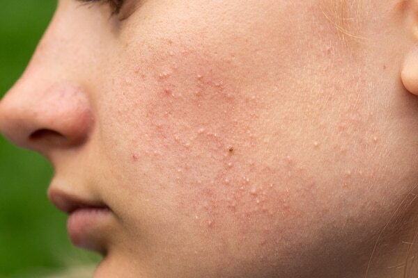 FAQs for comedonal acne