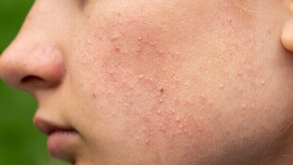 FAQs for comedonal acne