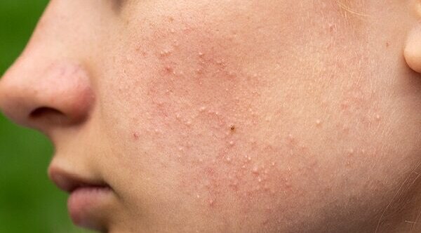 FAQs for comedonal acne