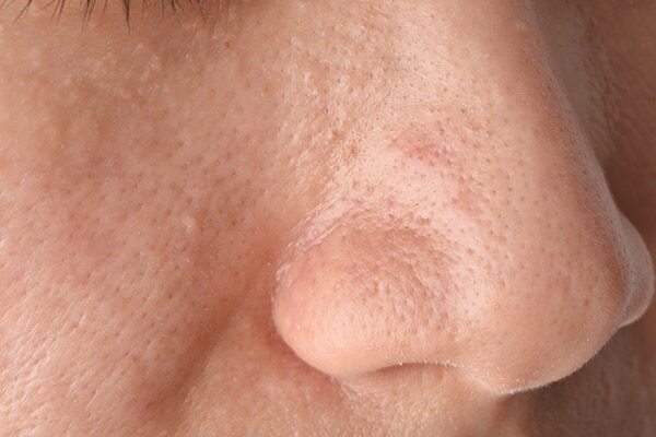 FAQs for comedonal acne