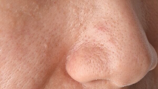 FAQs for comedonal acne