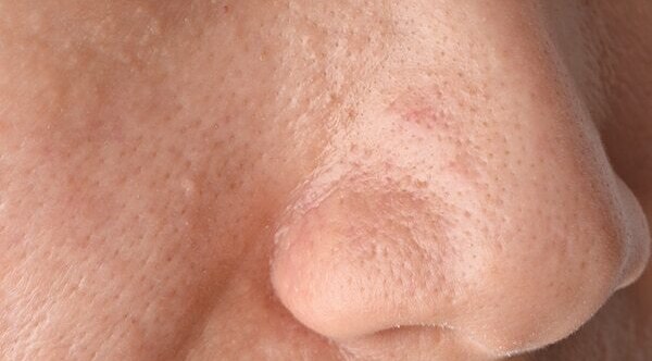 FAQs for comedonal acne