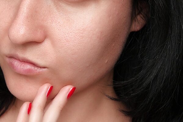 FAQs for comedonal acne