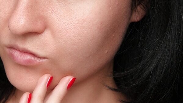 FAQs for comedonal acne