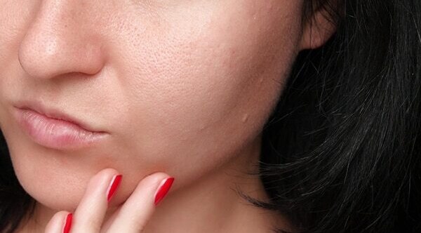 FAQs for comedonal acne