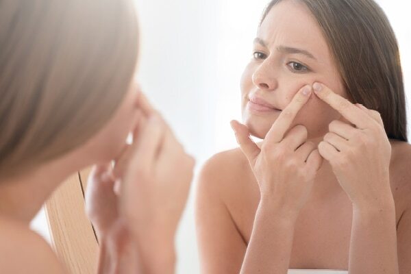 FAQs for comedonal acne