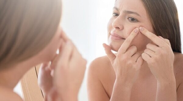 FAQs for comedonal acne