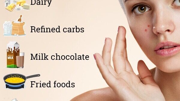 Basic skincare tips to prevent acne