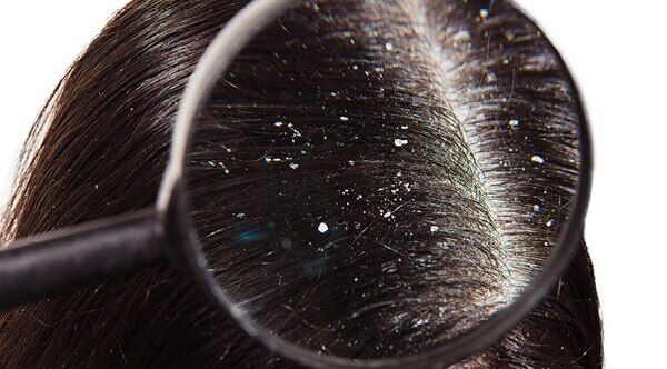 smelly hair causes
