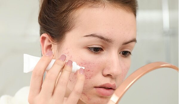5 Things To Keep In Mind when Using Spot Treatments