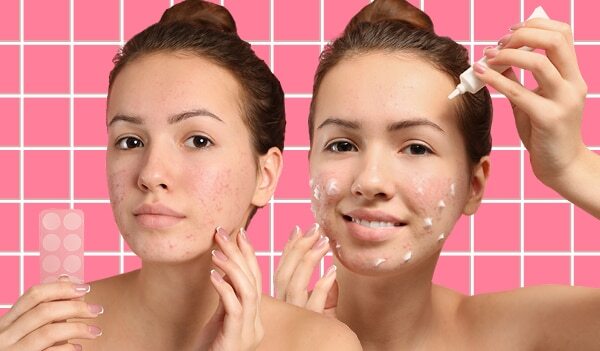 What's The Difference Between An Acne Patch And A Spot Treatment