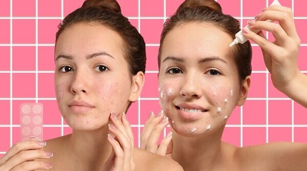 What's The Difference Between An Acne Patch And A Spot Treatment